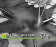 健康门诊：玻璃割断腕动脉，及时送医已无大碍