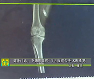 健康门诊：下蹲膝盖疼，半月板成型手术来修复